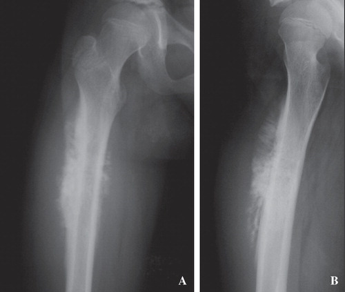 Figure 1.  Case1. Plain radiograms of the proximal femur revealed a mixed sclerotic and lytic intramedullary lesion with the periosteal perpendicular spiculation with extensive periosteal reaction and “Codman's triangle” reaction.