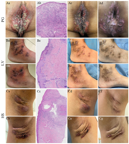 Figure 1 Patient (A) ulcerative lesions with massive purulent discharges in perianal area before abrocitinib treatment (Aa); extensive infiltration of lymphocytes and neutrophils and necrotising vasculitis (Ab, ×100); significant improvement of skin lesions 1 week after abrocitinib and cyclosporine A treatment (Ac) and 4 weeks after starting abrocitinib treatment (Ad). Patient (B) multiple ulcers and tan necrosis near both ankle joints (Ba, b); cellulose like degeneration of capillary wall, and vascular thrombosis and inflammation (Bc, ×100); markedly improvement of skin lesions 1 week (Bd, e) and 6 weeks (Bf, g) after abrocitinib treatment. Patient (C) nodules and abscesses of the axillary (Ca, b); hyperplasia of the hair follicle infundibulum epithelium and infiltration of lymphocyte (Cc, ×40); improvement of skin lesions 2 weeks after abrocitinib and doxycycline treatment (Cd, e) and 6 weeks after starting abrocitinib treatment (Cf, g).