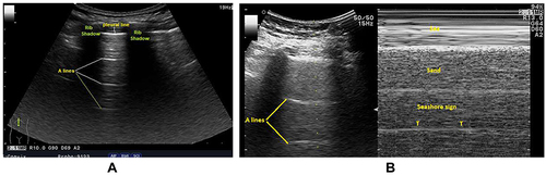 Figure 1 Lung ultrasonography of a mild COVID-19 case with a normal aerated lung. (A) A bright, thin, smooth pleural line between the two ribs and A-lines are seen as horizontal repetitions of the pleural line between the shadows of the two ribs. (B) Normal lung sliding (seashore sign using M mode). T: T lines are vertical lines, in time with cardiac pulsation, running from the pleural line to the bottom of the image.