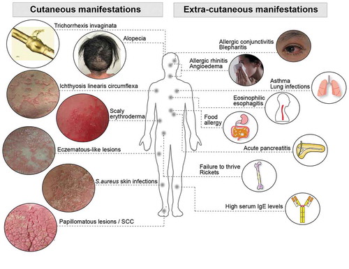 Figure 2. Netherton syndrome is a multisystem disease. A scheme summarizing the common cutaneous and extra-cutaneous manifestations observed in Netherton syndrome patients. Other extracutaneous manifestations such as hypothyroidism, thymic atrophy and acute bilateral renal vein thrombosis have been reported in rare cases. IgE, immunoglobulin E