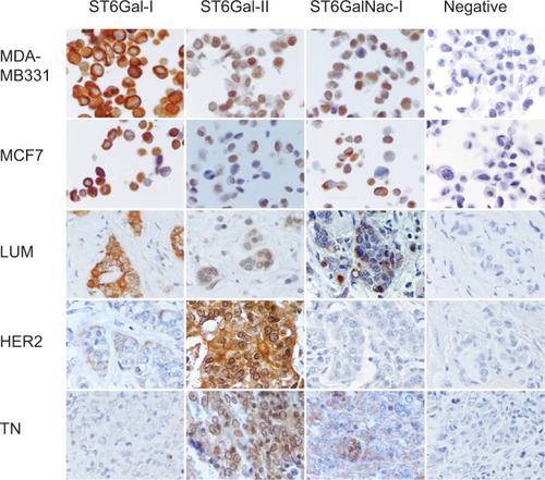 Figure 2 Immunohistochemical expression of ST6Gal-I, ST6Gal-II and ST6GalNac-I. Figure 3 Relationship between ST6Gal-I and TILs in different breast cancer subtypes.Notes: In HER2 tumors, low levels of ST6Gal-I are correlated with an increase in all lymphocyte subsets (*CD4: P = 0.01; **CD8: P = 0.02; ***CTL/NK: P = ns). On the right, statistical negative Spearmen’s correlations are documented for CD4 and CD8 positive T lymphocytes in HER2 breast carcinoma (regression line and 95% CI). For LUM and TN, we found no significant correlation. We conclude that high expression of ST6Gal-I in HER2 leads to reduced TILs.Abbreviations: TILs, tumor-infiltrating lymphocytes; HER2, human epidermal growth factor receptor 2; CTL/NK; cytotoxic T lymphocytes/natural killer lymphocytes; LUM, luminal; TN, triple negative; ns, not significant.Display full sizeNotes: Peroxidase-positive immunohistochemical staining in breast carcinomas: MDA-MB231 and MCF7 controls are positive for ST6Gal-I, ST6Gal-II and ST6GalNac-I. ST6Gal-I presents a high expression level in LUM. ST6Gal-II and shows a high expression in TN and HER2. ST6GalNac-I is expressed more in TN. ST6Gal-I shows diffuse cytoplasmic expression, ST6Gal-II shows diffuse cytoplasmic and perinuclear expression and ST6GalNac-I shows granular cytoplasmic positivity. LUM, HER2 and TN are the same case of Figure 1. Negative controls were performed with IgG1 negative control mouse or rabbit (Dako®) (400× magnification).Abbreviations: LUM, luminal; HER2, human epidermal growth factor receptor 2; TN, triple negative; IgG1, immunoglobulin G1.