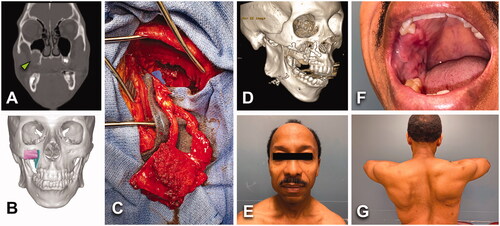 Figure 4. (A) A 54-year-old male with an asymptomatic 2.8 × 2.4 cm2 unicystic ameloblastoma of the right posterior maxilla (green arrowhead). History of high blood pressure treated with 2 antihypertensive agents. No tobacco/alcohol consumption. BMI of 22 kg/m2. (B) Virtual surgical planning helped to design a two-segments construct from scapular tip free flap. (C) Patient underwent to right partial maxillectomy via intraoral approach and right STFF. No tracheostomy was required. (D) Postoperative 3D CT scan showed stable bony structure. Length of stay of 6 days. (E–G) No major postoperative complications, but intraoral flap debulking was required to normalize occlusion.