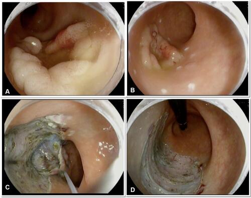 Figure 1 Steps of colonic ESD in the rectum using traction. (A) 4 cm rectal granular lateral spreading polyp with central depression but no evidence of invasive component. (B) The lesion marked with soft coagulation current. (C) Submucosal dissection with the help of snare traction. (D) Post-ESD resection bed.