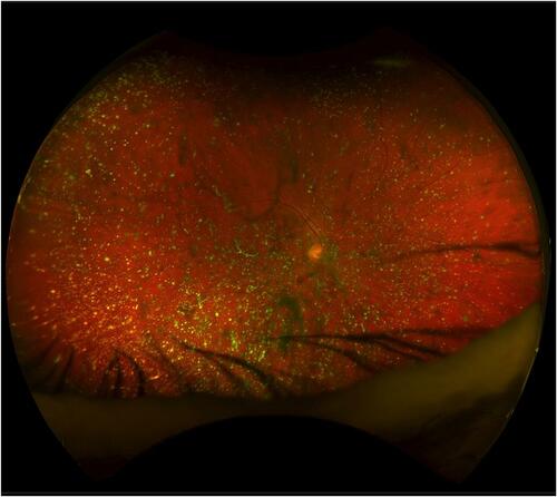 Figure 3 Scanning laser ophthalmoscopy-based systems such as OPTOS may enable retinal examination to a certain degree.