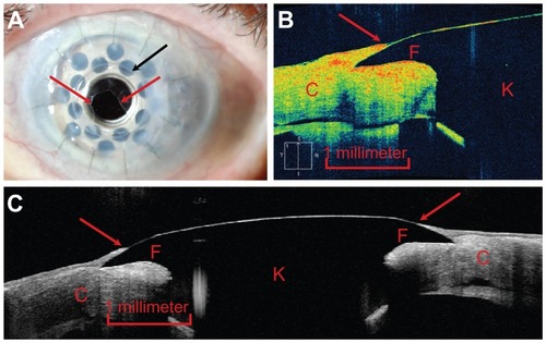 Figure 1 (A) Slit-lamp photograph demonstrating epithelium migrating onto the anterior surface of the front plate of the Boston type I keratoprosthesis (red arrows).Citation23 The edge of the front plate is identified by a black arrow. (B) Zeiss Cirrus HD-OCT image of the junction between the keratoprosthesis device (identified by the letter “K”) and the carrier donor corneal tissue (“C”) offering a cross-sectional view of the device-donor cornea interface. The epithelial tissue (red arrow) is visualized and seen to extend onto the front plate (“F”) and hence to cover the gap between the device and the carrier donor corneal tissue. (C) Heidelberg Spectralis Anterior Segment Module image of the device offering a comparable cross-sectional view, encompassing the entire front plate. Epithelial tissue coverage of the device-donor cornea interface (red arrows) is again visualized.
