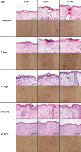 Figure 3. Histological observations for 10 min and 3, 14, 21 and 28 days after ablative fractional laser treatment. Representative slides of three patients (numbers 1, 2 and 6) were chosen for photo documentation. The granulomatous reaction with formation of multinucleated giant cells at high energy settings is marked with an asterisk. The corresponding clinical pictures of the treatment areas of one patient are given below.