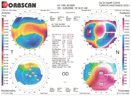 Figure 3 Patient’s postoperative Orbscan II® corneal topography imaging information.