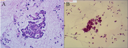 Figure 2 Pathology results. (A and B) Hematoxylin-eosin staining of endobronchial ultrasound-guided transbronchial needle aspiration biopsy specimen showed lung adenocarcinoma (10×).