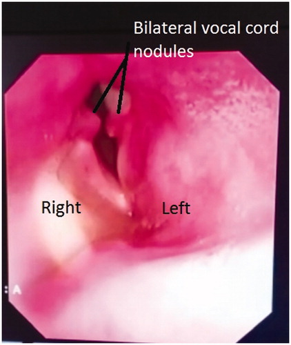 Figure 5. Flexiblescope view post extubation, note bilateral posterior 1/3 vocal cord nodules.