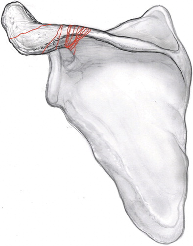 Figure 2. AP illustration of the scapula showing the 13 acromion fracture patterns seen in this cohort. The patterns together yield the “acromion fracture map.”