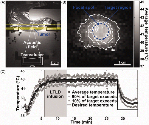 Figure 1. MRI-controlled focused ultrasound hyperthermia in rabbit VX2 tumour. (A) Axial T2-weighted MR image depicting experimental set-up with tumour-bearing rabbit lying on its side above a degassed water bath containing a mechanically positioned focused ultrasound transducer. Coronal image planes in which MR thermometry was used to measure temperature during heating are indicated; the middle plane, set at the depth of the ultrasound focus, was used to control treatment. (B) Time-averaged MRI temperature measurements in a coronal image plane through the tumour, demonstrating spatial temperature distribution achieved using MRI-controlled focused ultrasound hyperthermia. Desired temperature was 43°C in the 10 mm diameter targeted region (blue overlay). The focal spot width and scan trajectory are shown. (C) Experimental timeline for thermosensitive liposome administration and temperature control. Mean temperatures measured using MR thermometry within the 10 mm diameter target region are shown across three image planes (dark circles), as well as the temperatures that 90% (white circles) and 10% (grey squares) of the region exceeds. Thermosensitive liposome infusion started when target temperatures reached 42°C (shaded).