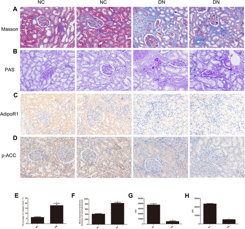 Figure 1 Histopathological examination of nondiabetic adjacent normal kidney tissues (NC) and renal biopsy sections from DN patients. Representative images showing (A) Masson’s trichrome staining, (B) PAS staining, (C) immunohistochemical staining for AdipoR1, and (D) immunohistochemical staining for p-ACC. All the images are magnified 200×. Quantitative analysis of the (E) percentage of the collagen fiber area, as shown by Masson’s trichrome staining, (F) Mean basement membrane thickness of renal tubules, as shown by PAS staining, (G) Cumulative optical density values for AdipoR1 and (H) p-ACC, as determined by immunohistochemistry. All the data are expressed as means ± SEMs (*p < 0.05 vs NC).