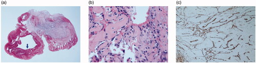 Figure 3. Histopathologic appearance of the lesion. (a) The specimen showed intravascular proliferative lesion with organizing thrombus (arrow) (H&E, ×15). (b) High magnification of papillary proliferations revealed fibrinous and hyaline stalks lined by endothelial cells (H&E, ×400). (c) These lining cells were positive for anti-CD31 (immunohistochemical stain, clone JC70, Cell Marque, ×100).