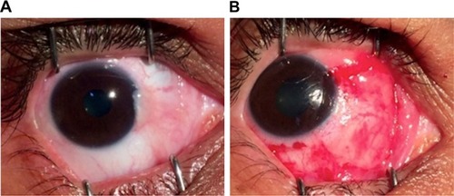 Figure 1 Illustrative example of surgical technique: pterygium removal followed by conjunctival autograft with fibrin glue fixation (A) before surgery, and (B) final appearance.