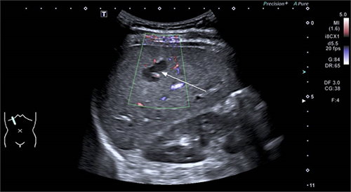 Figure 1 Abdominal ultrasound before surgery. A 19.9mm×14.2mm heterogeneous hypoechogenic nodule (white arrow) located at the right lobe of the liver.