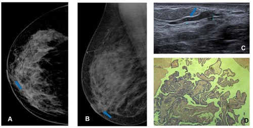 Figure 4 Right mammogram shows SDD (blue arrow) at cranio-caudal (CC) (A) and medio-lateral oblique (MLO) (B) mammogram view . Targeted US shows intraductal heterogeneous intraductal content (blue arrow) (C); H&E staining (x10) shows papilloma (D).