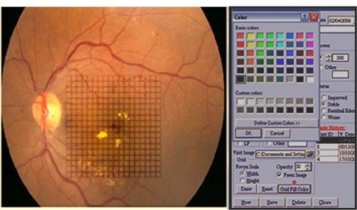 Figure 2 Amsler’s grid pattern is projected onto the fundus picture. Each square represent a one degree projection. The color palette is chosen from the drop down menu.