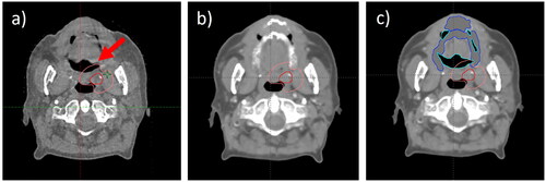 Figure 1. CBCT (a), synthetic CT (sCT) (b) and corrected sCT (sCTcorr) (c) of patient #1. GTV and CTV are displayed in red and Pink, respectively, and added water and air structures are displayed in blue and turquoise on c). the red arrow points at a part of the CTV that was contoured in air on the CBCT (a). the corresponding area on the sCT presents with tissue instead of air (b), which is corrected on the sCTcorr (c).