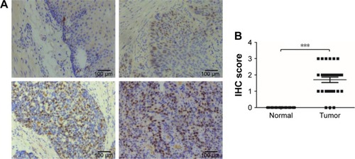Figure 2 CDC7 is highly expressed in ESCC tissues.Notes: (A) Representative IHC images of CDC7 expression in ESCC and matched adjacent normal tissues, top-left panel, negative staining in adjacent normal tissues; top-right panel, weak staining in ESCC; bottom-left panel, and moderate staining in ESCC; bottom-right panel, strong staining in ESCC. Magnification: 100×. (B) The IHC score of CDC7 was determined in ESCC and matched adjacent normal tissues; ***P<0.001.Abbreviations: ESCC, esophageal squamous cell carcinoma; IHC, immunohistochemistry.