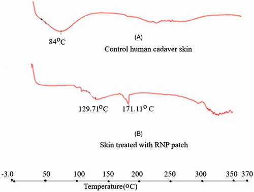Figure 7. DSC thermograms (Heat Flow, Endo Down): (A) Control human cadaver skin, (B) human cadaver skin treated with RNP patch F2. The DSC thermograms of skin samples were recorded using a DSC (Perkin Elmer (USA), Model- JADE DSC). The dried skin sample of about 5 mg was placed in an aluminium crimp pan and analysed between 30–350° C with heating rate of 10° C/min under nitrogen environment rutin in the treated skin was indicated by the endothermic peak at 171.11 °C in thermogram B.