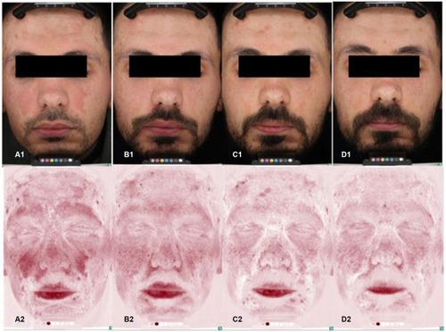 Figure 2 Standard and erythema-directed digital photography with VISIA-CR of a patient with moderate facial seborrheic dermatitis showing a significant reduction (P<0.001) in erythema at 15 days (erythema score: 2, B1–B2), 30 days (erythema score: 1, C1–C2), and 60 days (erythema score: 0, D1–D2) compared to baseline (erythema score: 3, A1–A2).