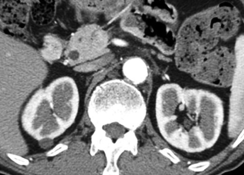 Figure 4. Enhanced CT after steroid administration shows improvement of multiple low-density lesions in the kidney.
