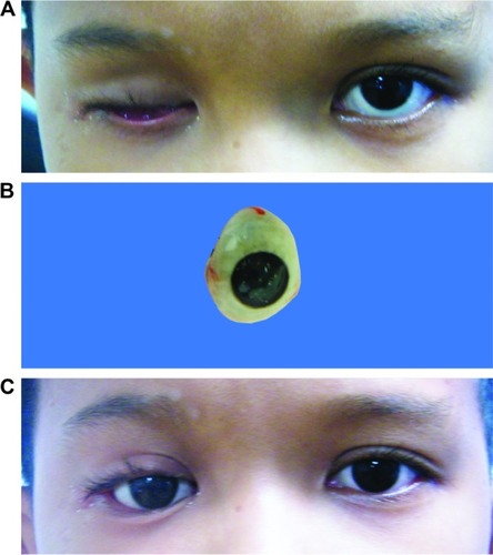 Figure 1 (A) Before the eye prosthesis wearing, a boy who underwent evisceration with no orbital implant when he was 3 months old. He could not wear the eye prosthesis because of volume insufficiency and shallow fornice. After that he underwent the dermis-fat graft with lateral tarsal strip procedure when he was 3 years old. (B) The custom-made eye prosthesis. (C) After the eye prosthesis wearing at 6-year-postoperative dermis-fat graft.