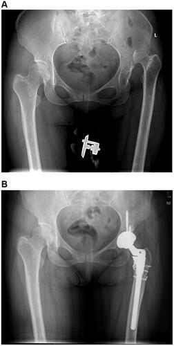 Figure 3 X-ray of a 42-year-old woman undergoing THA with subtrochanteric osteotomy. (A) Pre-operative X-ray. (B) Post-operative X-ray.