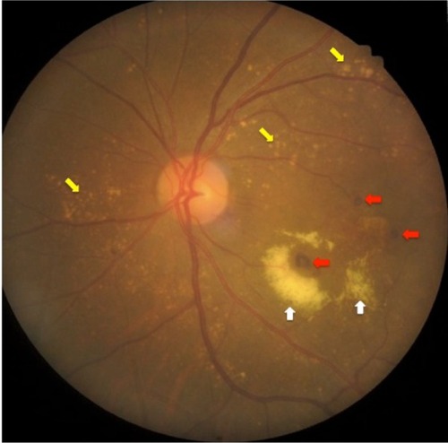 Figure 1 Fundus findings of most patients in the study.