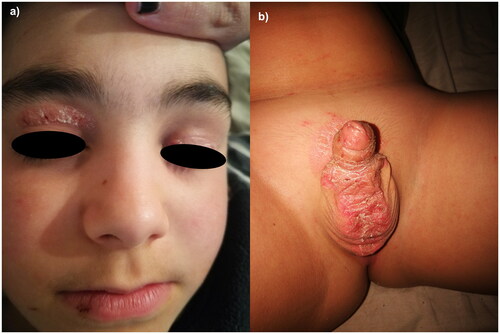 Figure 1: Psoriasis involving the face (Figure 1(a)) and genitals (Figure 1(b)) of a 12-year-old boy before the start of ustekinumab.
