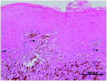 Figure 2. Microscopic photo of the second incisional biopsy specimen. Proliferating atypical oval- to spindle-shaped cells containing brownish granules suspected to be melanin in the lower layer of the squamous epithelium and subepithelium. The melanoma cells are scattered in the upper layer of the squamous epithelium (as shown with black arrows), which are regarded as ascending melanocytes.