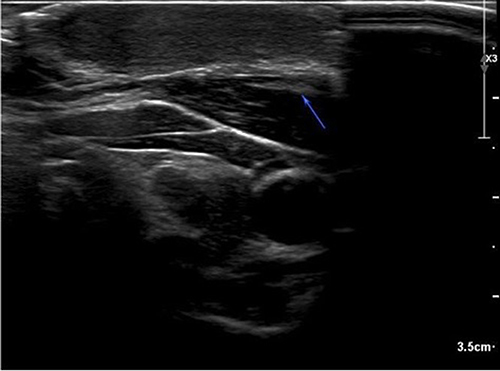 Figure 4 Ultrasound imaging of the keloid scar showing metallic clips over the bottommost part of the scar labeled by the blue arrow.