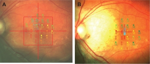 Figure 4 Microperimetric findings. Findings before (A) and 3 years after (B) two intravitreal injections of bevacizumab. Fixation indicated by small blue dots is improved.