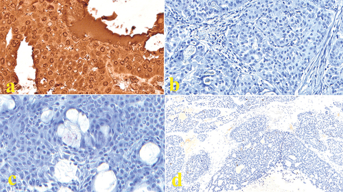 Figure 1. Micrograph showing (a) Immunoreactive deposits appeared as reddish-brown reactions where the target antigen was located (MENA) in conventional low-grade MEC (40×); (b) Negative immunostaining for CD133 in low-grade oncocytic MEC (40×); (c) Negative immunostaining for CD44 in low-grade oncocytic MEC (40×). (d) Negative immunostaining for OCT4 in high-grade solid MEC (10×).