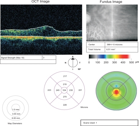 Figure 3 Central foveal thickness 18 months after presentation.