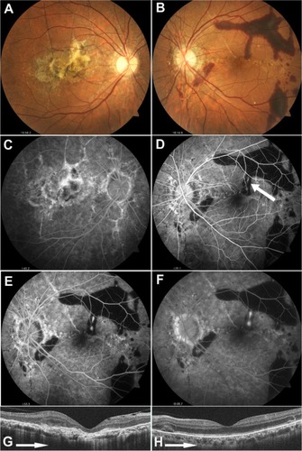 Figure 1 Fundus findings on initial examination.