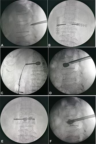 Figure 2 At the biplane monitoring, the puncture (A, B), balloon dilatation (C, D), and cement injection (E, F) were performed stepwise. Notably, when the needle arrived at the posterior wall of the vertebral body in the sagittal plane of fluoroscopic view, the intraoperative puncture revealed extension of the puncture needle beyond the inner edge of the projection of the pedicle in the coronal plane, suggesting a large abduction angle of the needle (A, B).