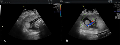 Figure 1 (A) Aberrant placental lobe (B) The relationship with umbilical vessels as demonstrated by color Doppler flow.
