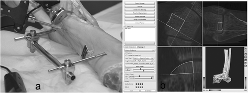 Figure 3. Pair-point matching with anatomical landmarks in situ and on the CAS monitor (green and red dots mark deviation).