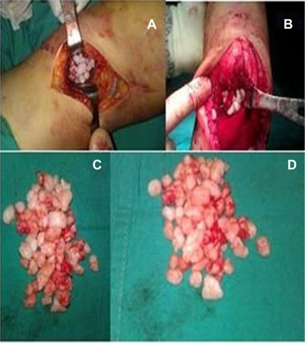Figure 4 Chondral components removed during (A and B) and after (C and D) surgery can be seen.