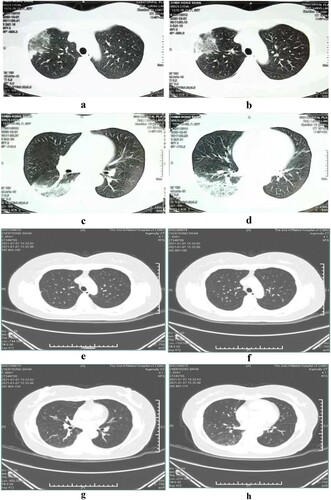Figure 2. Serial chest computed tomography (CT) scans of the 40-year-old female with psittacosis pneumonia (the second patient). The initial CT scan (5 days after the onset) shows infiltrates, reticular shadows and consolidations with bronchograms in the right upper lobe (a, b) and right lower lobe (c, d). The follow-up CT scan (22 days after the onset) shows the area of infiltrates and consolidations in the right upper lobe (e, f) and right lower lobes (g, h) have both disappeared.