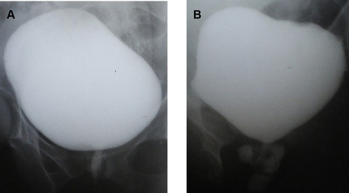 Figure 5 Voiding cystourethrogram shows a complex multilocular diverticulum filled with contrast agent at the level of the midurethra.