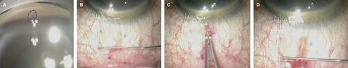 Figure 7 Final steps of Transconjunctival ab externo XEN Gel Stent implantation: implant in the angle [blue circle] (A) and the subconjunctival space (B); repositioning of Stent after deployment with non-toothed forceps (C); repositioned Stent showing 3 mm in the subconjunctival space (D). Image courtesy of Won Kim, MD.
