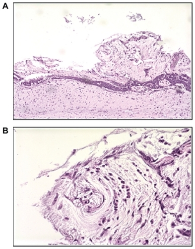 Figure 2 A) Low and B) high power fields showing histologic appearance of crust type bursitis showing reactive lymphoid mucosa with necrotic tissue.