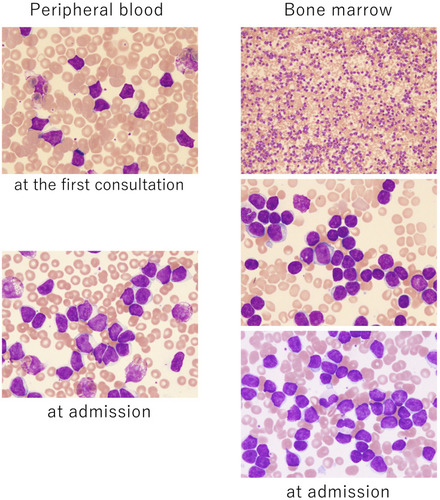 Figure 3 CLL cells from peripheral blood at first consultation and admission and BM at admission showed mature small monoclonal lymphocytes with narrow cytoplasm, concentrated nuclei, and partially aggregated chromatin without transformation to a large cell type (H&E ×40 and ×200).