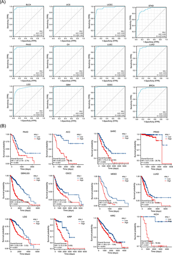 Figure 4 Prognostic values of KNL1 expression in pan-cancer. (A) Diagnostic ROC curves were used to predict the diagnostic value of KNL1 in pan-cancer. (B) Survival difference of OS between KNL1-low and KNL1-high in pan-cancer.