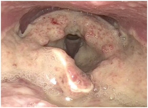 Figure 1. Fiberoptic evaluation of the patient’s larynx. All supraglottic structures are covered with dense polypoid lesions.