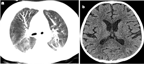 Figure 1 (a) Chest CT showed pulmonary inflammation; (b) Brain CT showed ventriculomegaly on admission.