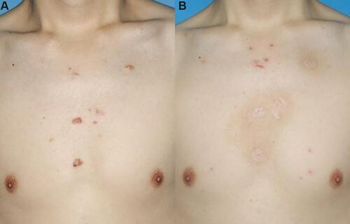 Figure 3 A patient with multiple lesions of keloids on his chest prior to treatment (A) and 1 year after PSR treatment with 2 radiation therapy thereafter (B). No recurrence was found.