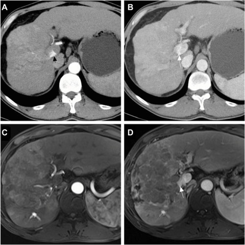Figure 1 Tumor response of patients in the group with transarterial chemoembolization with drug-eluting beads.Notes: A 48-year-old male with hepatocellular carcinoma and grade 3 arterioportal shunt: contrast-enhanced computed tomography scan showed a hepatic arterial phase hyperattenuation lesion with a maximal diameter of 106.5 mm, the arterial flow was drained into the main portal vein (black arrow) (A), and the portal venous phase showed tumor thrombus (white arrow) (B); a follow-up magnetic resonance scan was performed after 3 months, showing that the maximal diameter of the tumor was increased to 151.8 mm and indicating a tumor response of progression disease, the hepatic arterial phase (C), and the portal venous phase (D).